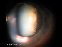 posterior subcapsular cataract