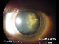 posterior subcapsular cataract