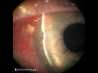 peripheral ulcerative keratitis (PUK) in rheumatoid arthritis