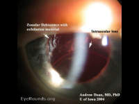pseudoexfoliation zonular dehiscence