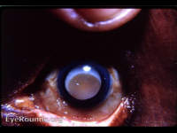 hypermature Morgagnian cataract