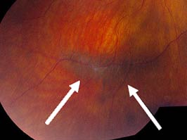 perivascular lattice degeneration