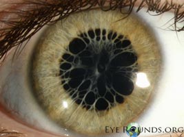 Persistent pupillary membranes