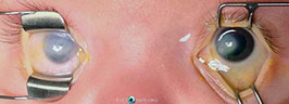 Bilateral congenital corneal opacification secondary to Peters anomaly