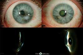 Peters anomaly with bilateral paracentral corneal opacities associated with areas of iridocorneal touch