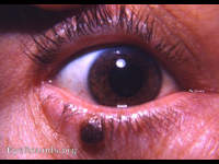 pigmented nevus of lower lid