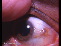 conjunctiva: pinguecula