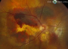 Polypoidal choroidal vasculopathy