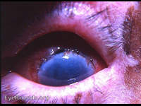 post-op cataract complications