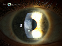 Post-PRK corneal haze