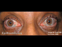 Scleritis, scleral thinning