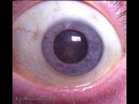 posterior subcapsular cataract