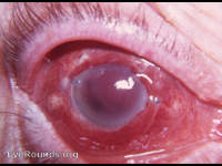 hyphema: post cataract surgery