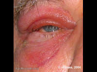 Preseptal cellulitis