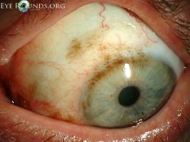 Primary Acquired Melanosis