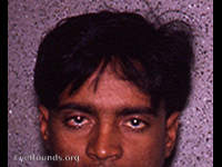 ptosis trachomatosa