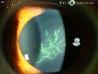 Varicella-zoster virus (VZV) epithelial keratitis with Pseudodendrites