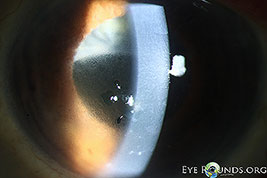 Pseudophakic Bullous Keratopathy