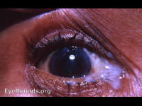 purulent dacryocystitis