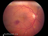 retinal arterial macroaneurysm