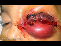 retrobulbar hemorrhage