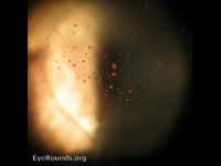 retinal detachment - Schaffer's sign