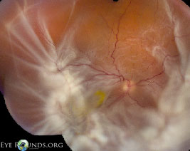 retinal detachment with proliferative vitreoretinopathy