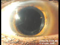 RK (radial keratotomy)
