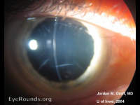 AK (astigmatic keratotomy)