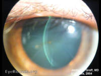 RK (radial keratotomy) with tear star