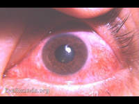 recurrent corneal abrasion