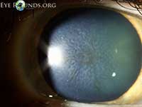 Reis-Bucklers corneal dystrophy