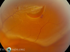 Rhegmatogenous retinal detachment
