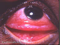 Conjunctivitis: with unusual ridge reaction