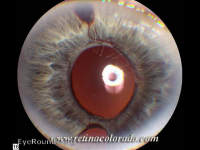 Rubeosis associated with Retinal Detachment