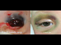 bullous subconjunctival hemorrhage from orbital roof fracture