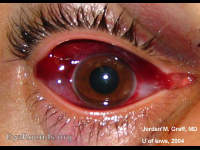 Bullous sub-conjunctival hemorrhage, early