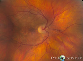 Situs inversus