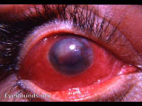 Sympathetic ophthalmia - the exciting eye