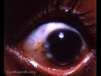 Salzmann's nodular degeneration / dystrophy of the cornea