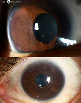 Sarcoidosis