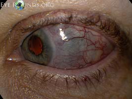 Scleritis