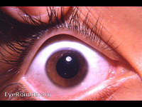sectorial heterochromia iridis
