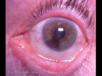 iris nevus: sectorial heterochromia