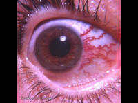 Sturge-Weber Syndrome