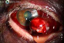 Subconjunctival Hematoma