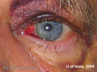 Subconjunctival Hemorrhage