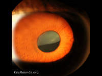 ectopia lentis