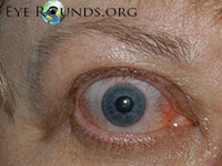thyroid Eye Disease