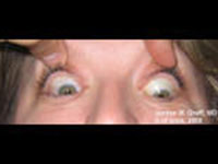 Thyroid eye disease
